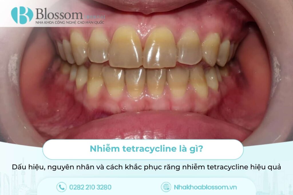Nhiễm tetracycline là gì? Dấu hiệu, nguyên nhân và cách khắc phục răng nhiễm tetracycline hiệu quả