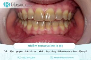Nhiễm tetracycline là gì? Dấu hiệu, nguyên nhân và cách khắc phục răng nhiễm tetracycline hiệu quả