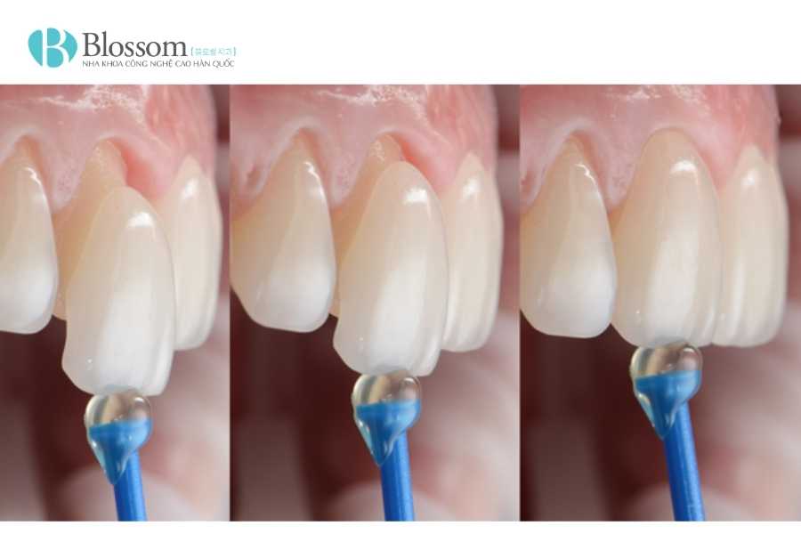 Răng sâu có dán sứ được không? Giải pháp phục hình phù hợp cho từng mức độ sâu răng 2 rang sau co dan su duoc khong 2