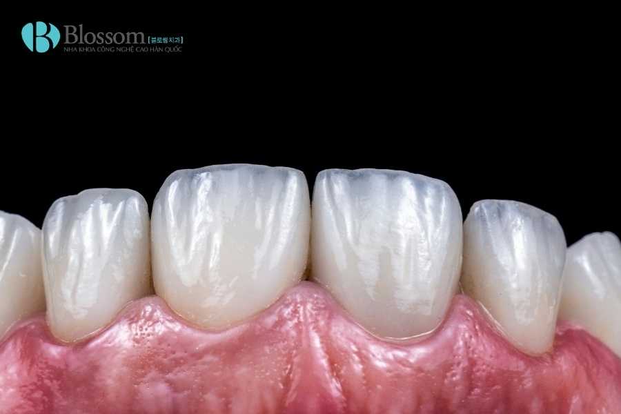 Răng sâu có dán sứ được không? Giải pháp phục hình phù hợp cho từng mức độ sâu răng 4 rang sau co dan su duoc khong 4