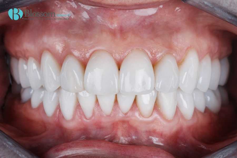 Răng sâu có dán sứ được không? Giải pháp phục hình phù hợp cho từng mức độ sâu răng 5 rang sau co dan su duoc khong 5