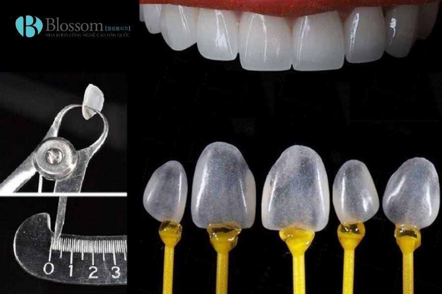 Răng sứ không mài là gì? Ưu nhược điểm và khi nào nên làm răng sứ không mài 1 rang su khong mai 1 1