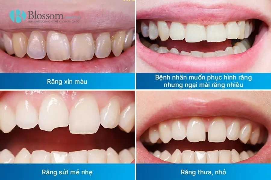 Răng sứ không mài là gì? Ưu nhược điểm và khi nào nên làm răng sứ không mài 2 rang su khong mai 2 1