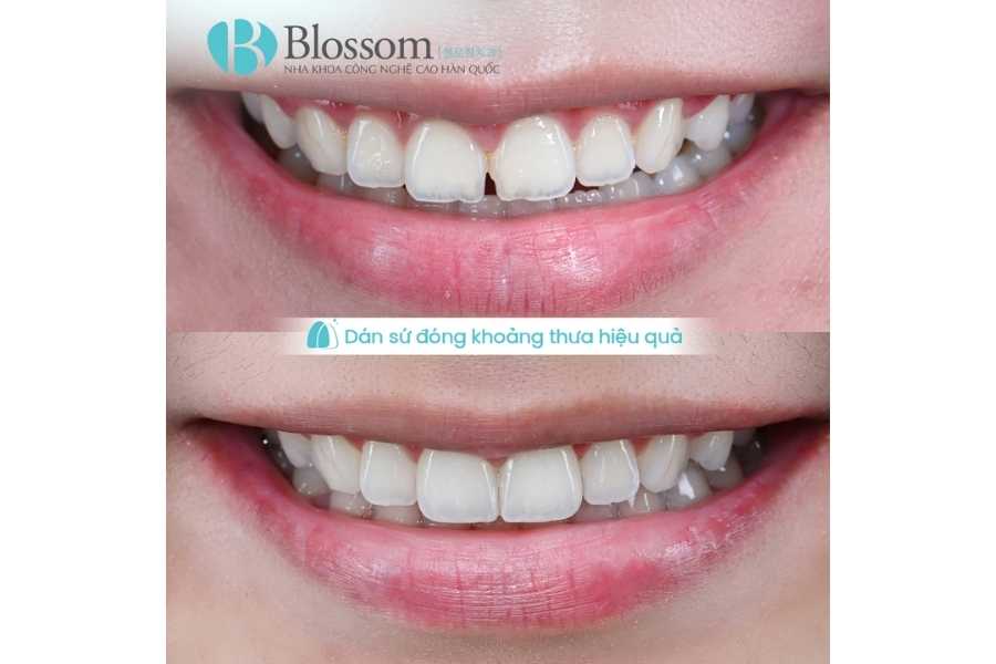 Răng sứ không mài là gì? Ưu nhược điểm và khi nào nên làm răng sứ không mài 3 rang su khong mai 3 1