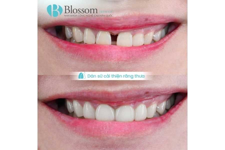 Răng sứ không mài là gì? Ưu nhược điểm và khi nào nên làm răng sứ không mài 4 rang su khong mai 4 1