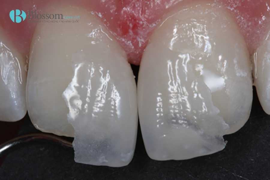 Trường hợp nào nên dán sứ không mài? Ai phù hợp và khi nào không nên thực hiện 1 truong hop nao nen dan su khong mai 1 1