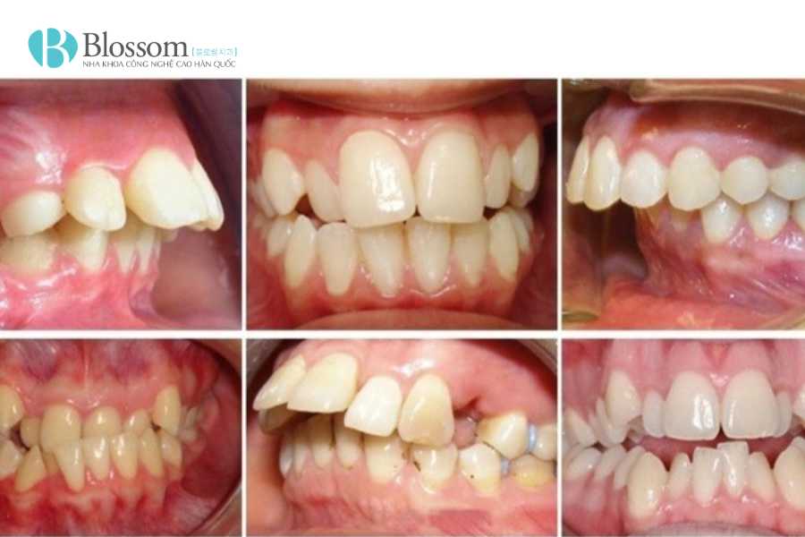 Trường hợp nào nên dán sứ không mài? Ai phù hợp và khi nào không nên thực hiện 3 truong hop nao nen dan su khong mai 3 1