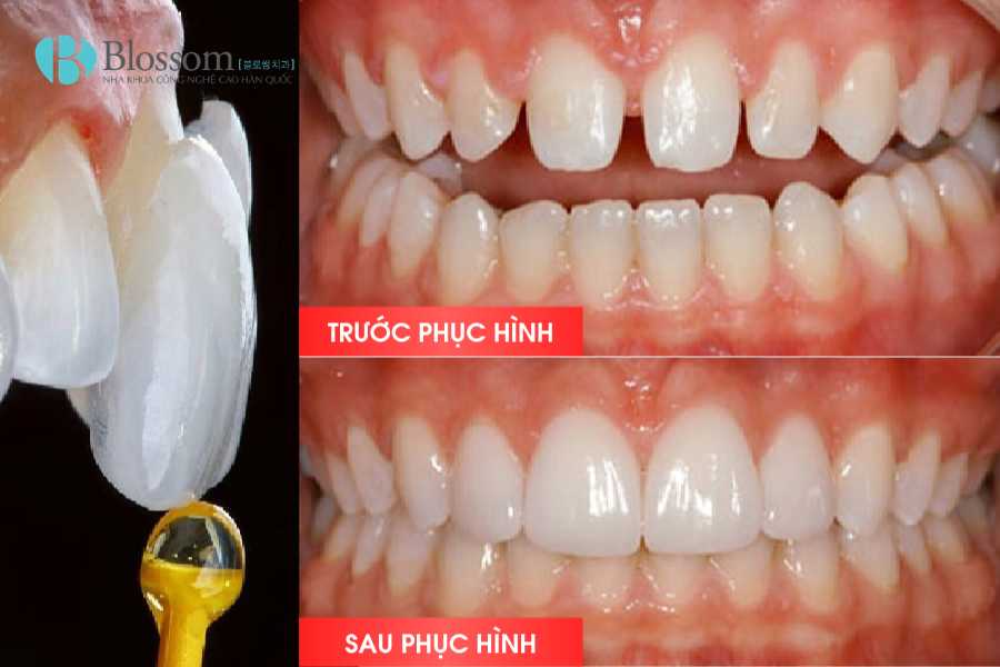 Trường hợp nào nên dán sứ không mài? Ai phù hợp và khi nào không nên thực hiện 4 truong hop nao nen dan su khong mai 4 1