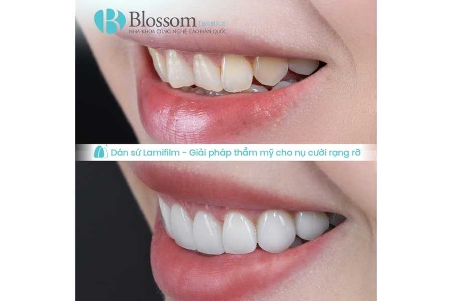 Trường hợp nào nên dán sứ không mài? Ai phù hợp và khi nào không nên thực hiện 5 truong hop nao nen dan su khong mai 5 1