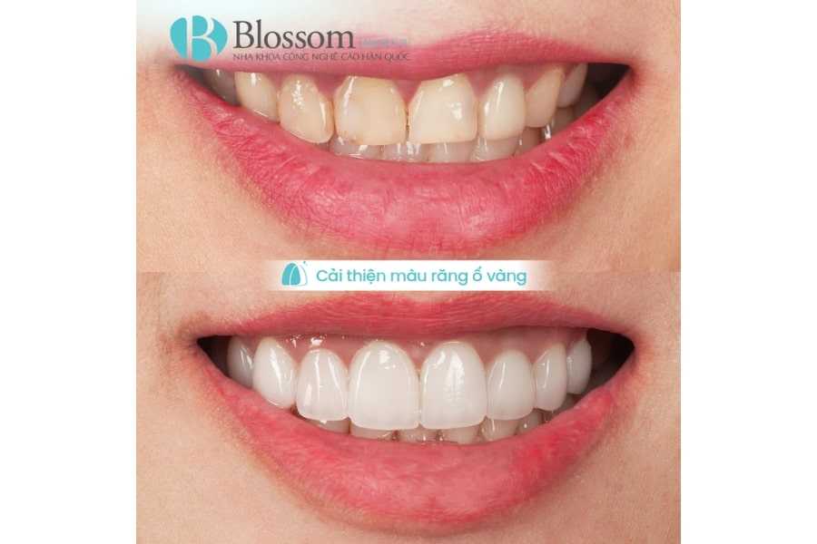 Trường hợp nào nên dán sứ không mài? Ai phù hợp và khi nào không nên thực hiện 6 truong hop nao nen dan su khong mai 6 1