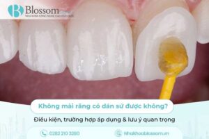 Không mài răng có dán sứ được không? Điều kiện, trường hợp áp dụng & lưu ý quan trọng
