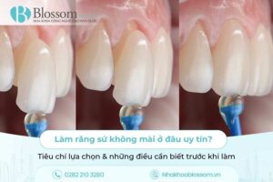 Làm răng sứ không mài ở đâu uy tín? Tiêu chí lựa chọn & những điều cần biết trước khi làm