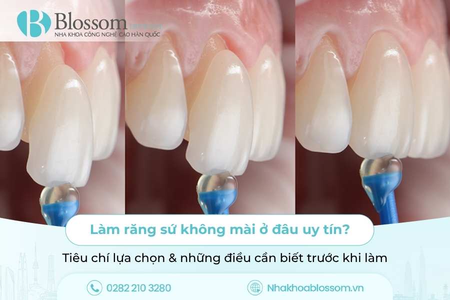 Làm răng sứ không mài ở đâu uy tín? Tiêu chí lựa chọn & những điều cần biết trước khi làm