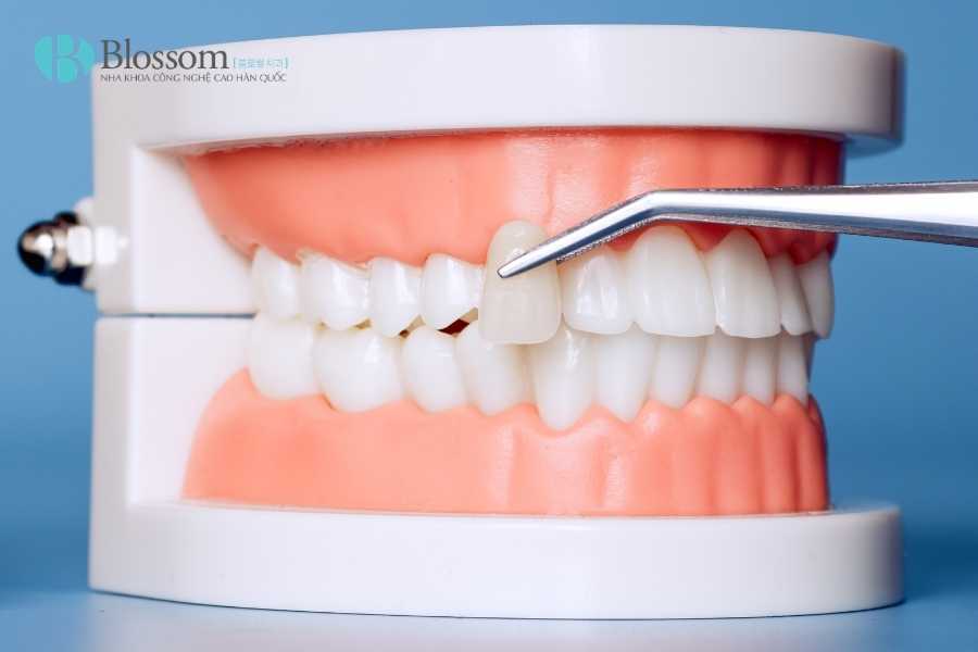 Không mài răng có dán sứ được không? Điều kiện, trường hợp áp dụng & lưu ý quan trọng 1 khong mai rang co dan su duoc khong 1