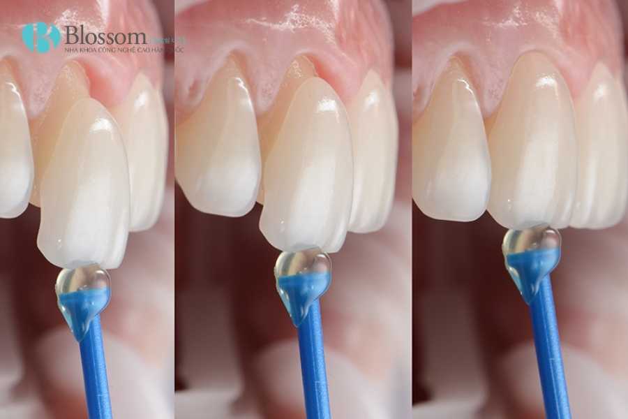 Không mài răng có dán sứ được không? Điều kiện, trường hợp áp dụng & lưu ý quan trọng 2 khong mai rang co dan su duoc khong 2