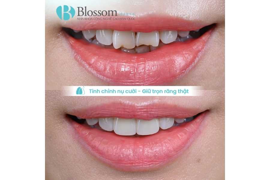 Không mài răng có dán sứ được không? Điều kiện, trường hợp áp dụng & lưu ý quan trọng 3 khong mai rang co dan su duoc khong 3