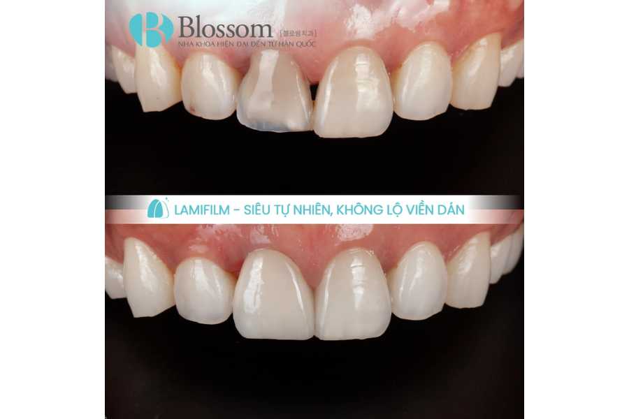 Không mài răng có dán sứ được không? Điều kiện, trường hợp áp dụng & lưu ý quan trọng 5 khong mai rang co dan su duoc khong 5