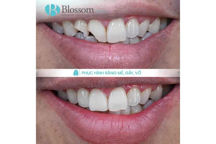 Không mài răng có dán sứ được không? Điều kiện, trường hợp áp dụng & lưu ý quan trọng 7 khong mai rang co dan su duoc khong 7