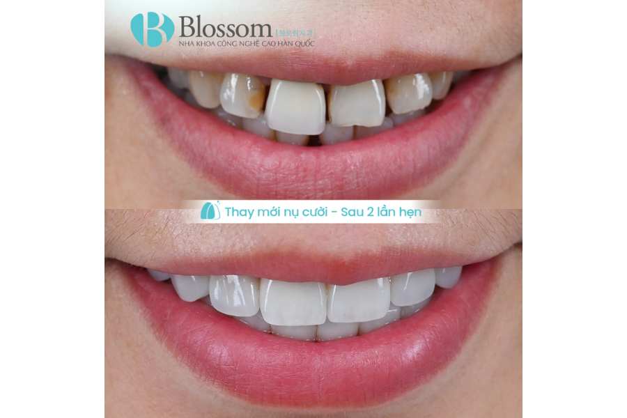 lam rang su khong mai o dau 5