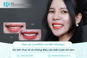 Dán sứ Lamifilm có bền không? Độ bền thực tế và những điều cần biết trước khi làm