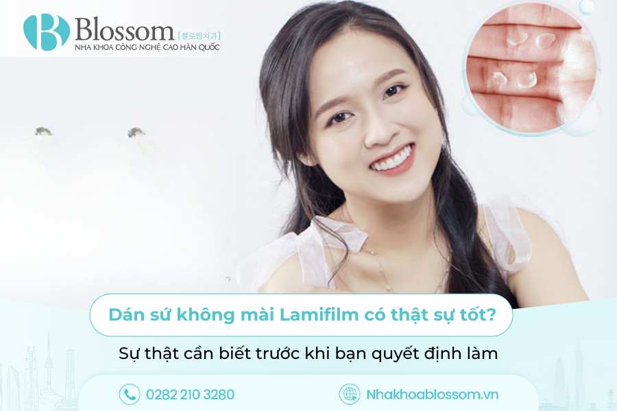 Dán sứ không mài Lamifilm có thật sự tốt? Sự thật cần biết trước khi bạn quyết định làm