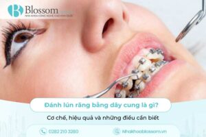 Đánh lún răng bằng dây cung là gì? Cơ chế, hiệu quả và những điều cần biết