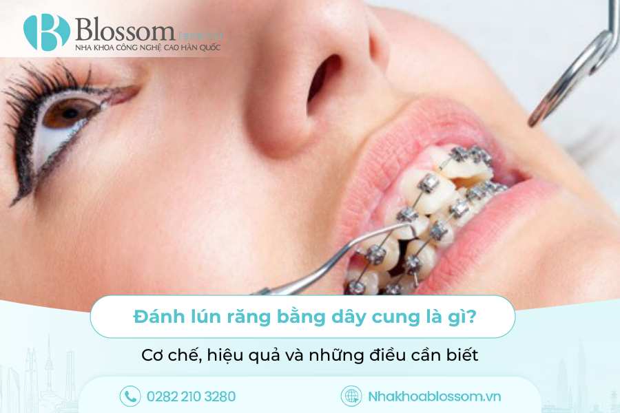 Đánh lún răng bằng dây cung là gì? Cơ chế, hiệu quả và những điều cần biết