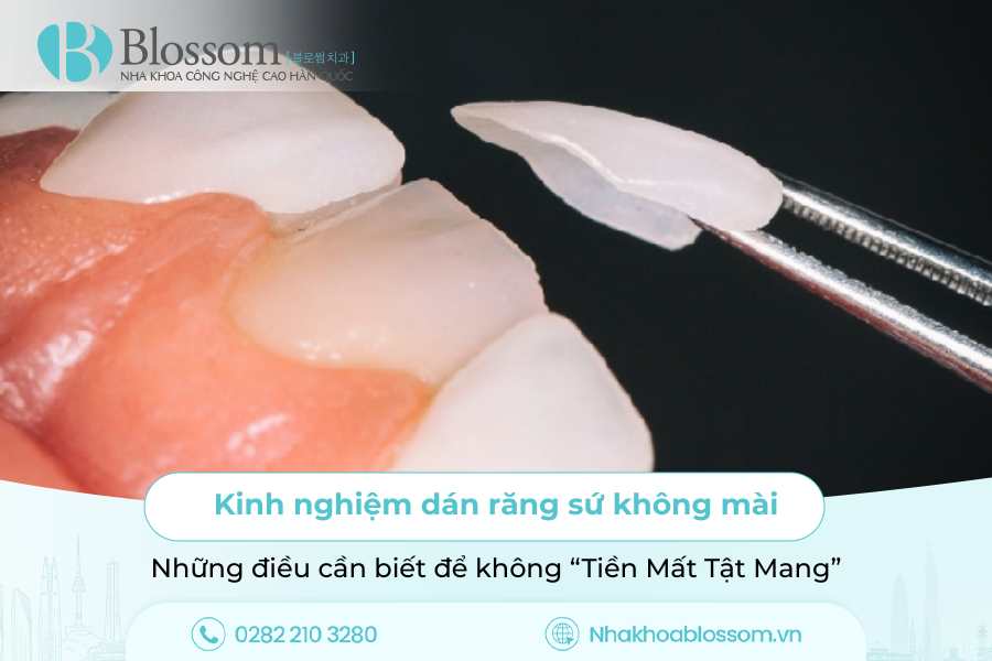 Kinh nghiệm dán răng sứ không mài: Những điều cần biết để không “Tiền Mất Tật Mang”