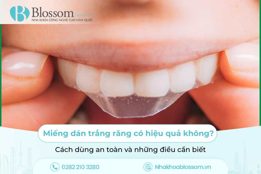 Miếng dán trắng răng có hiệu quả không? Cách dùng an toàn và những điều cần biết