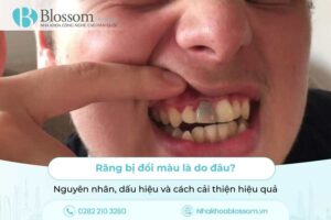 Răng bị đổi màu là do đâu? Nguyên nhân, dấu hiệu và cách cải thiện hiệu quả