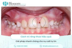 Cách trị răng thưa hiệu quả: Giải pháp nhanh chóng cho nụ cười tự tin