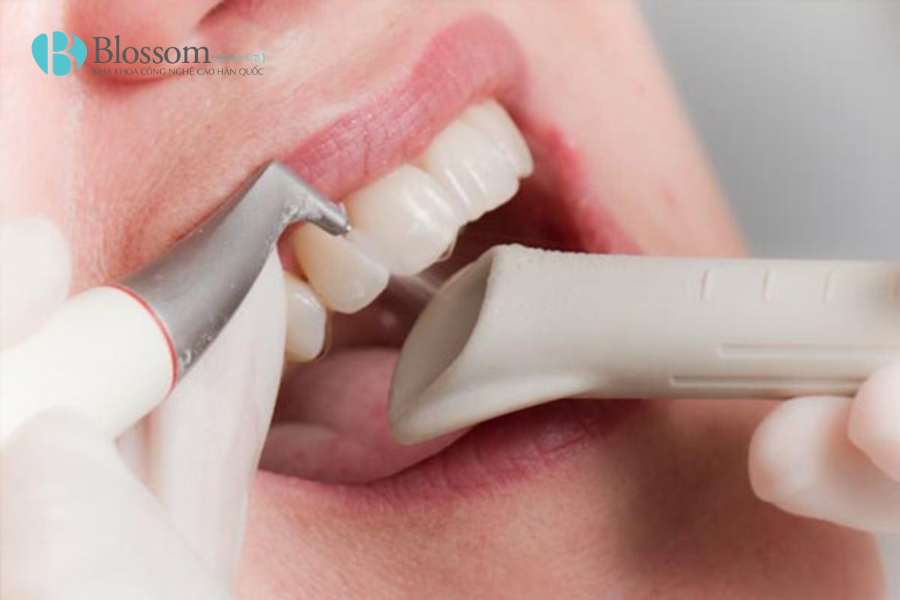 Cạo vôi răng có trắng răng không? Sự thật bạn cần biết trước khi làm 2 cao voi rang 2