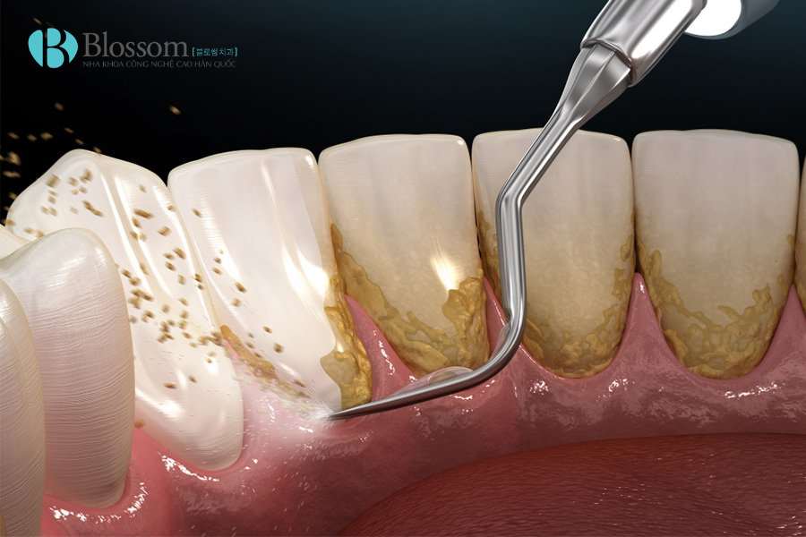 Cạo vôi răng có trắng răng không? Sự thật bạn cần biết trước khi làm 1 cao voi rang 3