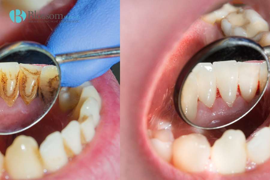 Cạo vôi răng có trắng răng không? Sự thật bạn cần biết trước khi làm 4 cao voi rang 4