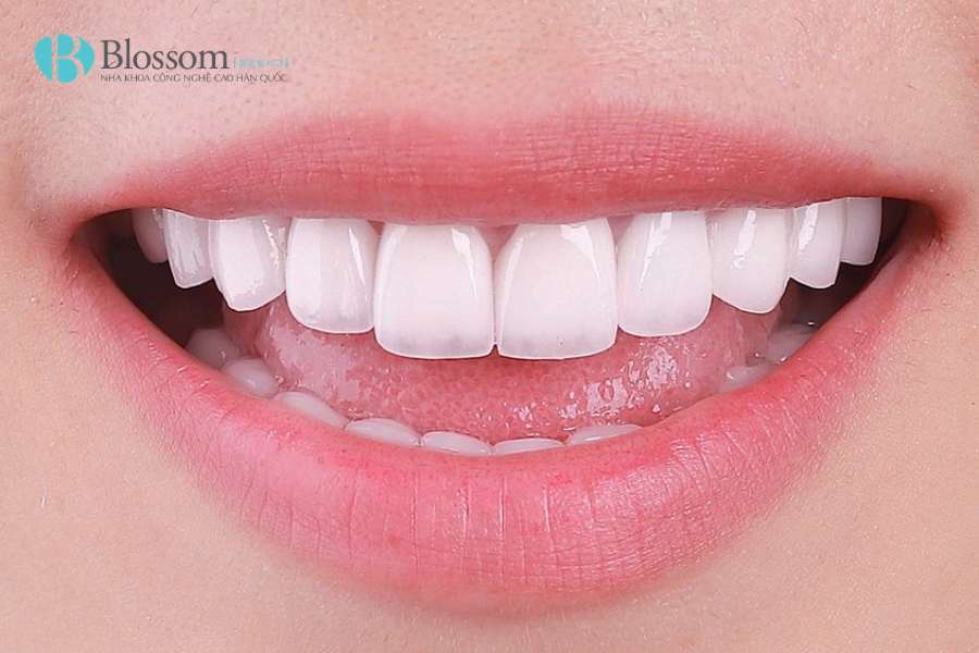Cạo vôi răng có trắng răng không? Sự thật bạn cần biết trước khi làm 5 cao voi rang 5