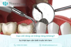 Cạo vôi răng có trắng răng không? Sự thật bạn cần biết trước khi làm