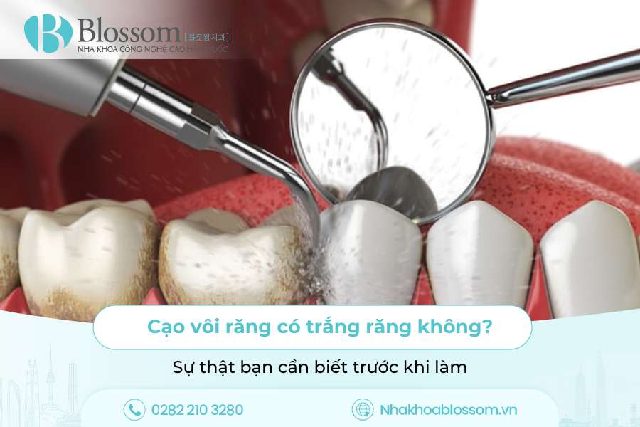 Cạo vôi răng có trắng răng không? Sự thật bạn cần biết trước khi làm