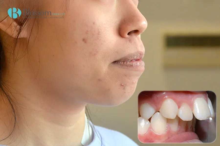 Chỉnh Răng Hô Là Gì? Các Phương Pháp Hiệu Quả Giúp Cải Thiện Nhanh Chóng 1 chinh rang ho 1