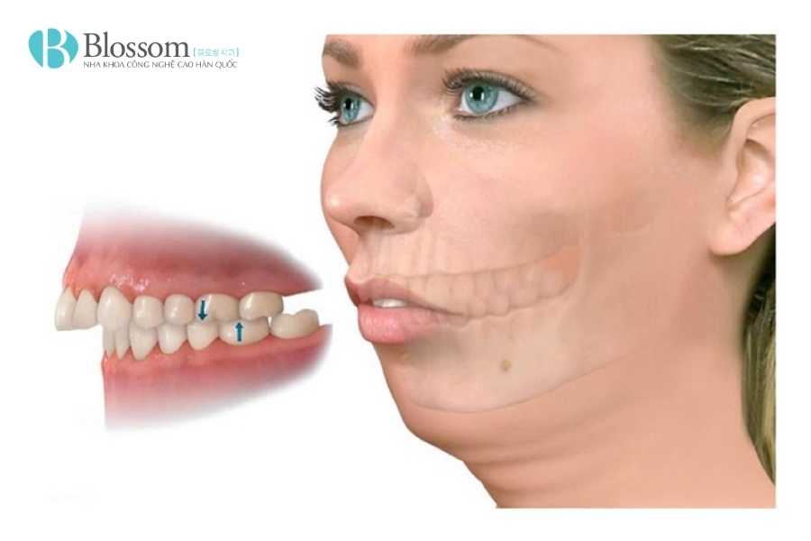 Chỉnh Răng Hô Là Gì? Các Phương Pháp Hiệu Quả Giúp Cải Thiện Nhanh Chóng 2 chinh rang ho 2