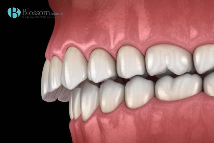Chỉnh Răng Hô Là Gì? Các Phương Pháp Hiệu Quả Giúp Cải Thiện Nhanh Chóng 3 chinh rang ho 3