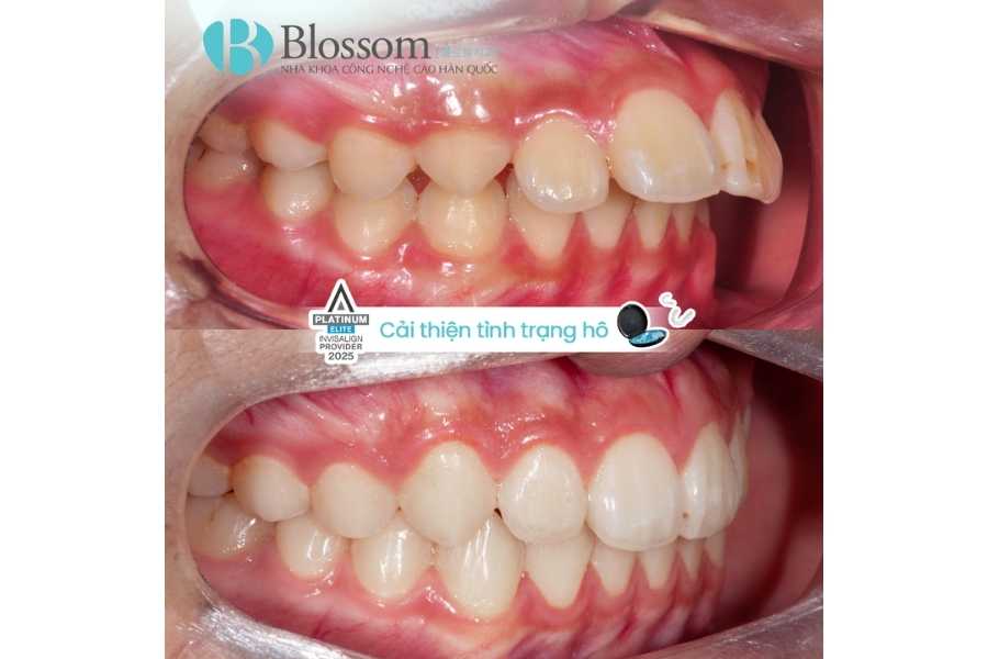 Chỉnh Răng Hô Là Gì? Các Phương Pháp Hiệu Quả Giúp Cải Thiện Nhanh Chóng 4 chinh rang ho 4