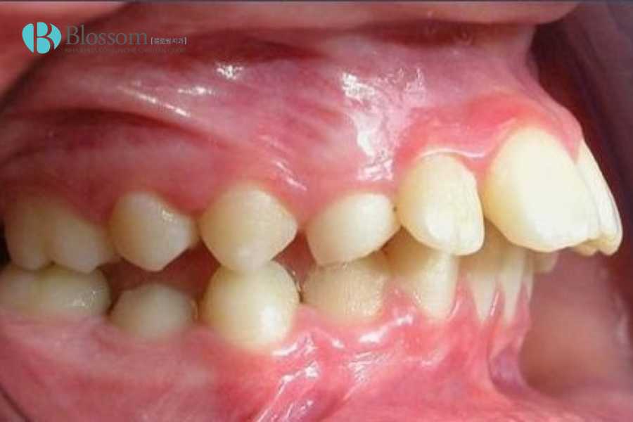 Chỉnh Răng Hô Là Gì? Các Phương Pháp Hiệu Quả Giúp Cải Thiện Nhanh Chóng 5 chinh rang ho 5