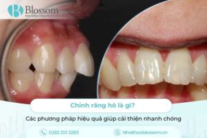 Chỉnh Răng Hô Là Gì? Các Phương Pháp Hiệu Quả Giúp Cải Thiện Nhanh Chóng
