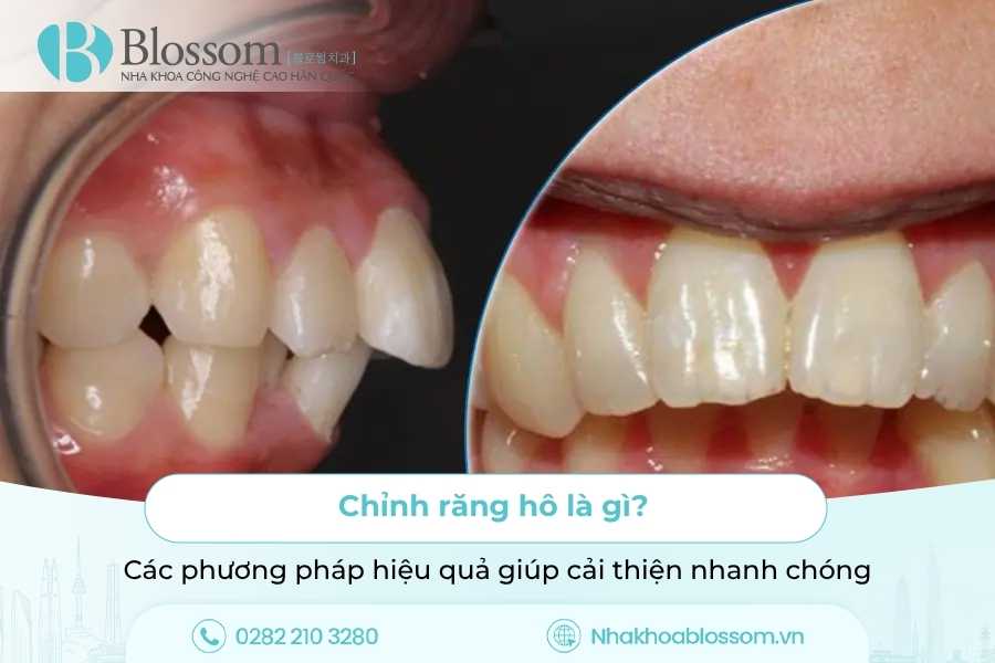 Chỉnh Răng Hô Là Gì? Các Phương Pháp Hiệu Quả Giúp Cải Thiện Nhanh Chóng