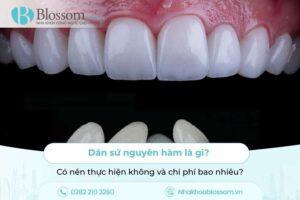 Dán sứ nguyên hàm là gì? Có nên thực hiện không và chi phí bao nhiêu?