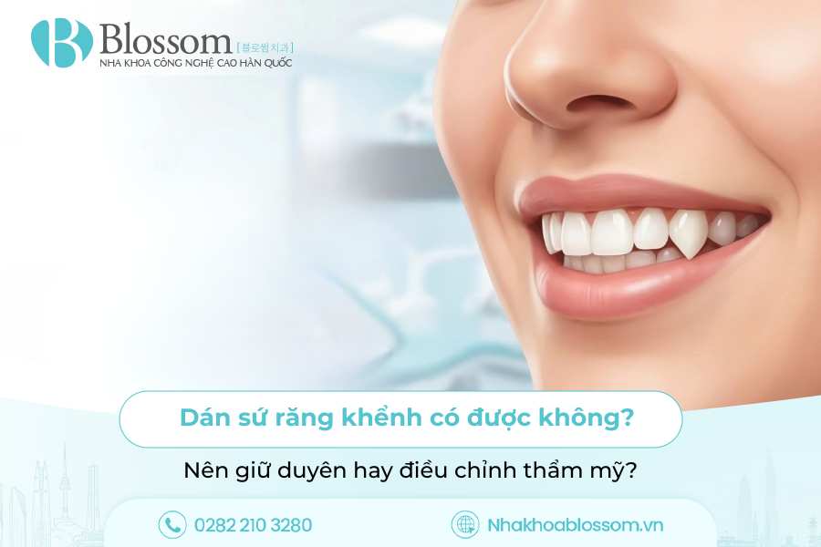 Dán sứ răng khểnh có được không? Nên giữ duyên hay điều chỉnh thẩm mỹ?