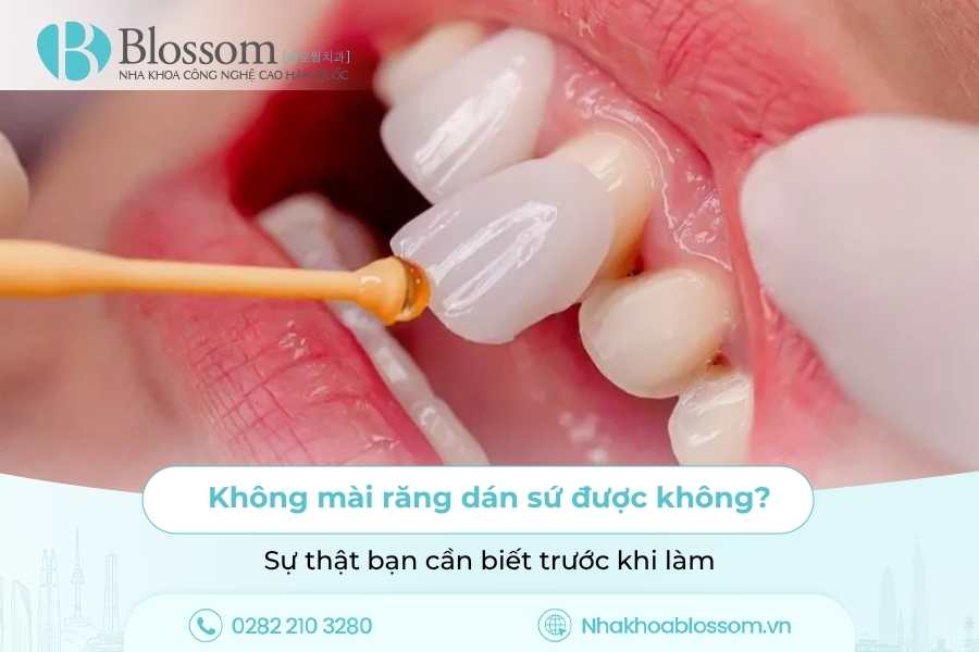 Không mài răng dán sứ được không? Sự thật bạn cần biết trước khi làm