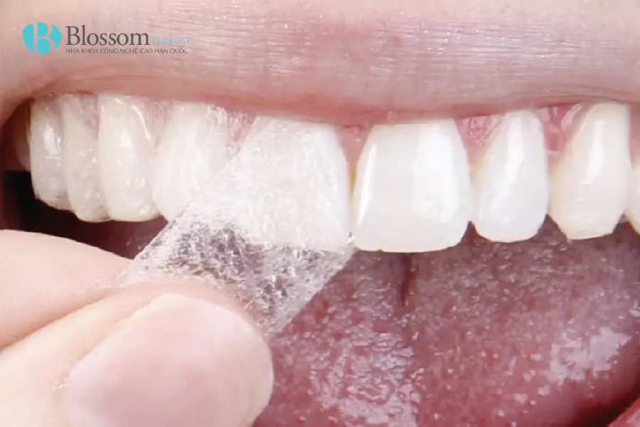 Miếng dán trắng răng có hiệu quả không? Cách dùng an toàn và những điều cần biết 2 mieng dan trang rang 2