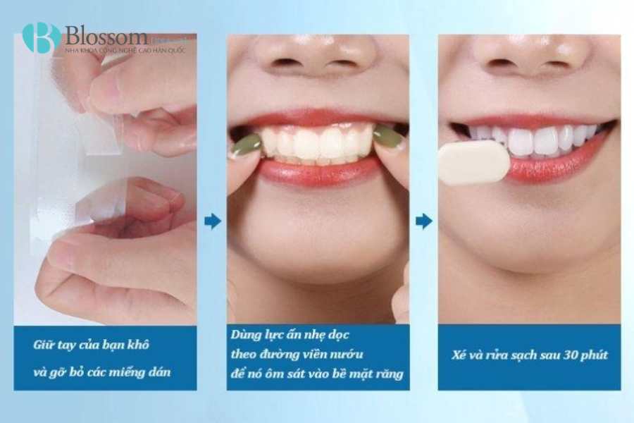 Miếng dán trắng răng có hiệu quả không? Cách dùng an toàn và những điều cần biết 3 mieng dan trang rang 3