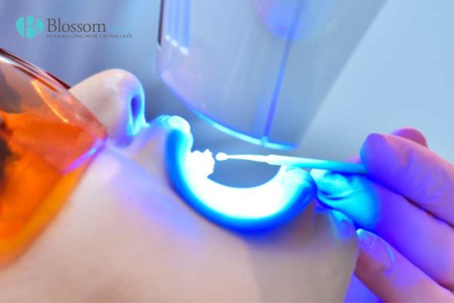 Miếng dán trắng răng có hiệu quả không? Cách dùng an toàn và những điều cần biết 5 mieng dan trang rang 5